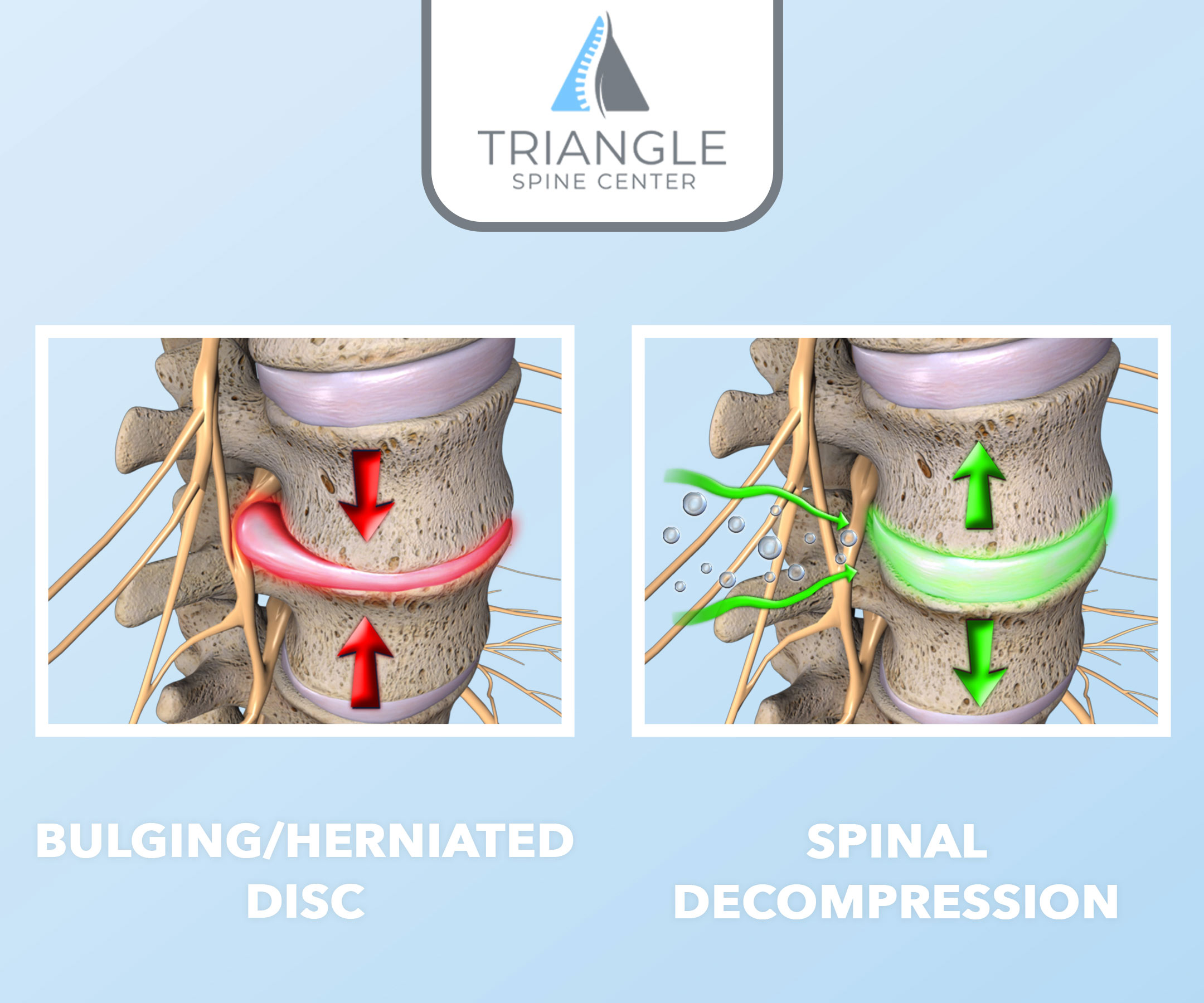 Strap Spinal Decompression  Y-Strap Spinal Decompression